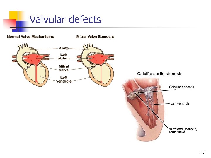 Valvular defects 37 