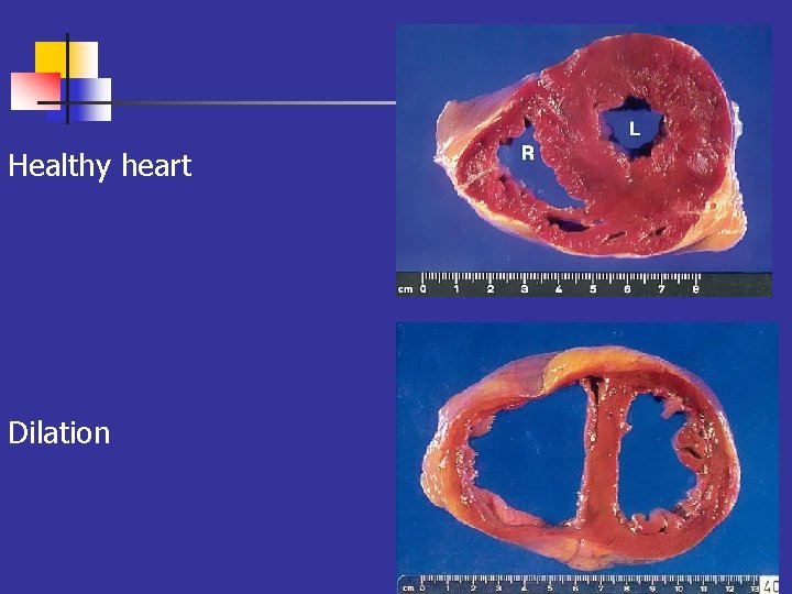 Healthy heart Dilation 38 