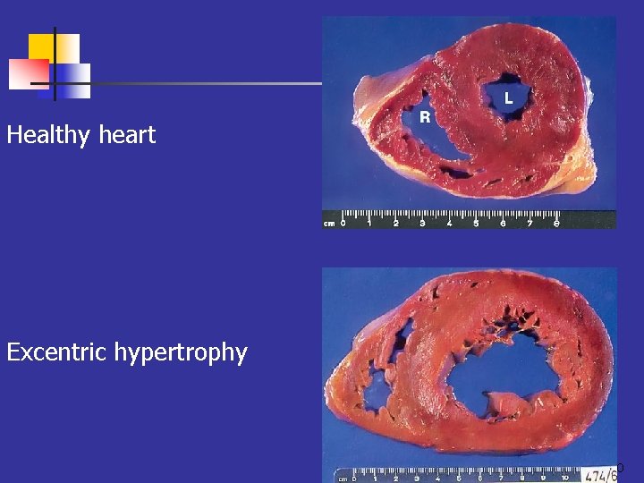 Healthy heart Excentric hypertrophy 40 