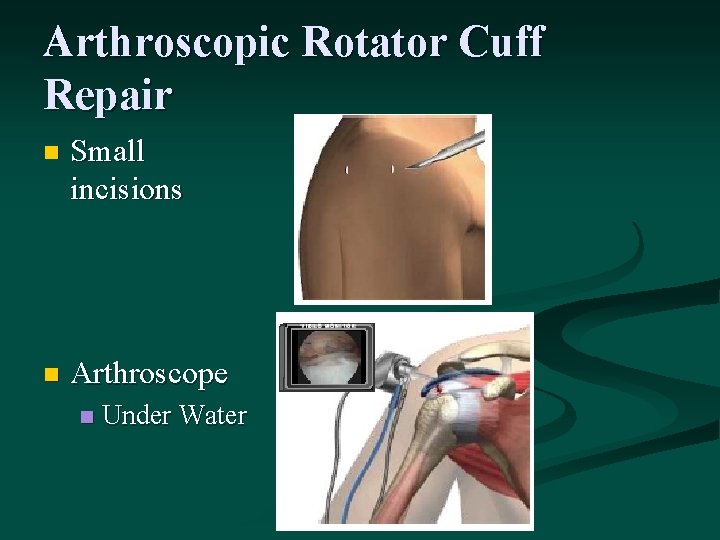 Arthroscopic Rotator Cuff Repair n Small incisions n Arthroscope n Under Water 