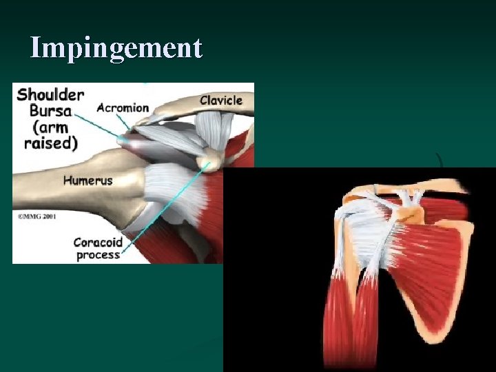 Impingement 