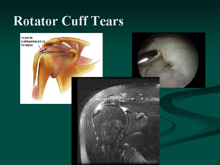 Rotator Cuff Tears 