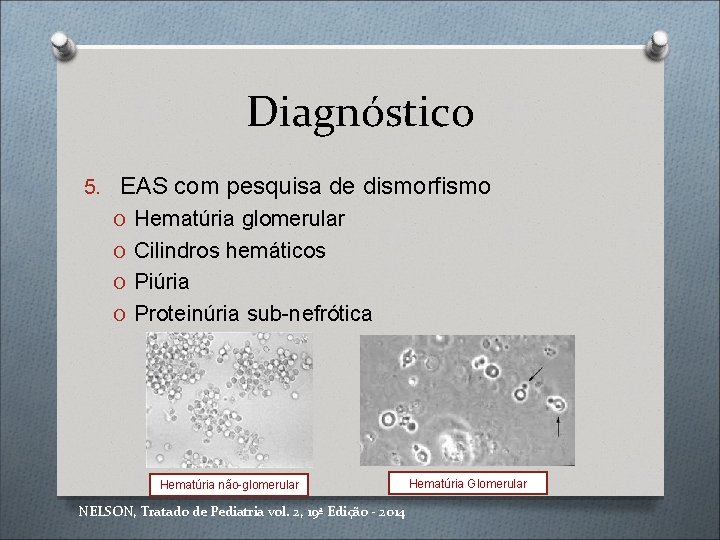 Diagnóstico 5. EAS com pesquisa de dismorfismo O Hematúria glomerular O Cilindros hemáticos O