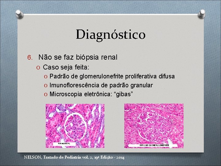 Diagnóstico 6. Não se faz biópsia renal O Caso seja feita: O Padrão de