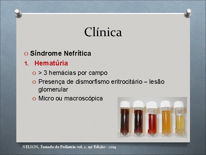 Clínica O Síndrome Nefrítica 1. Hematúria O > 3 hemácias por campo O Presença