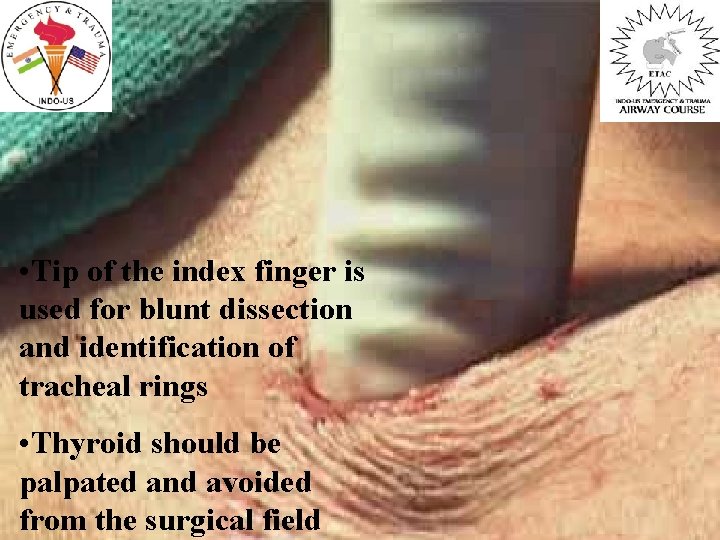  • Tip of the index finger is used for blunt dissection and identification