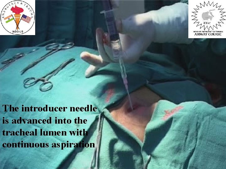 The introducer needle is advanced into the tracheal lumen with continuous aspiration 
