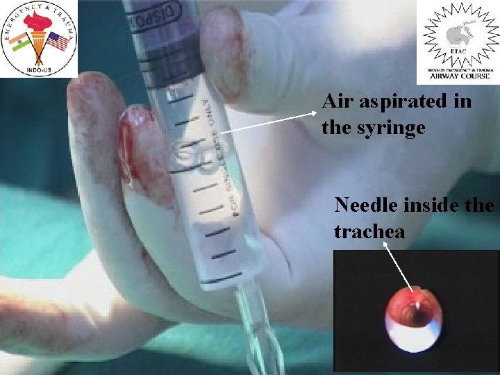Air aspirated in the syringe Needle inside the trachea 