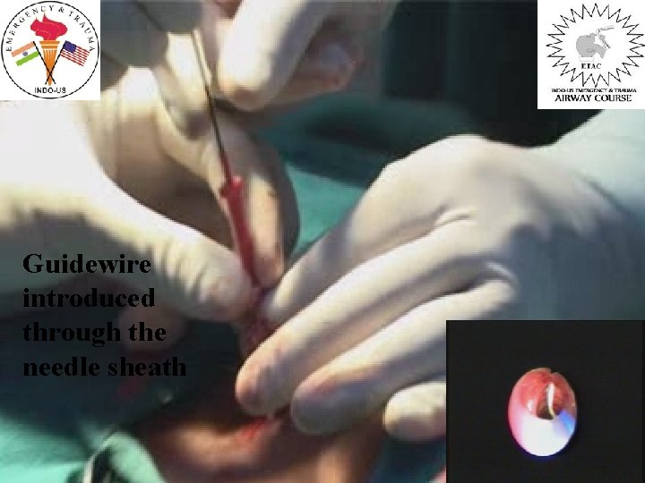 Guidewire introduced through the needle sheath 