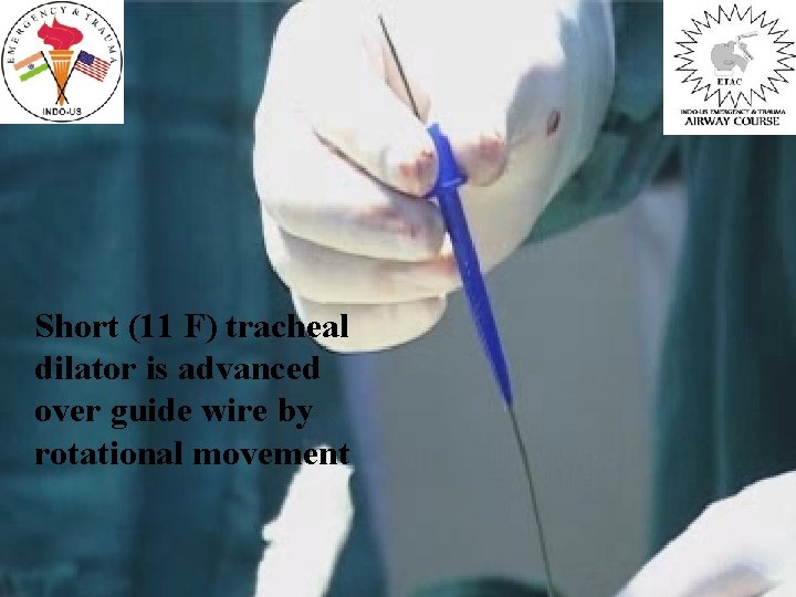 Short (11 F) tracheal dilator is advanced over guide wire by rotational movement 