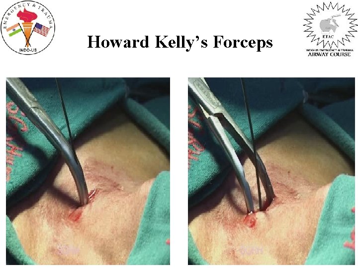 Howard Kelly’s Forceps 