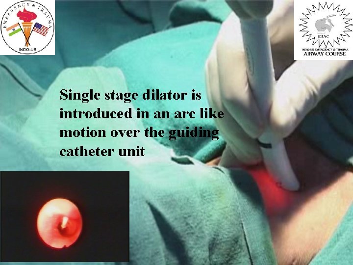 Single stage dilator is introduced in an arc like motion over the guiding catheter