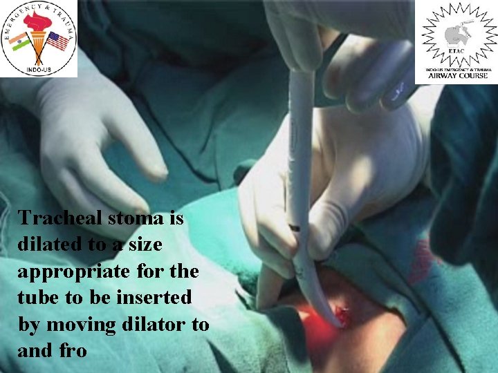 Tracheal stoma is dilated to a size appropriate for the tube to be inserted