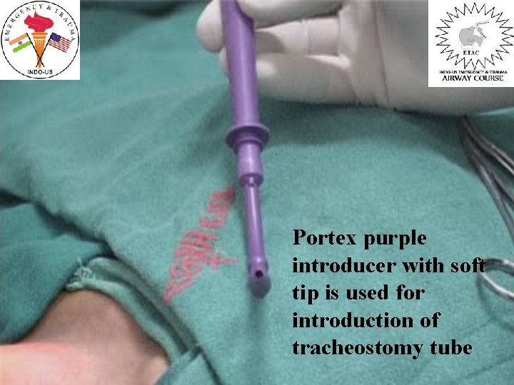 Portex purple introducer with soft tip is used for introduction of tracheostomy tube 