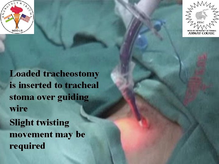 Loaded tracheostomy is inserted to tracheal stoma over guiding wire Slight twisting movement may
