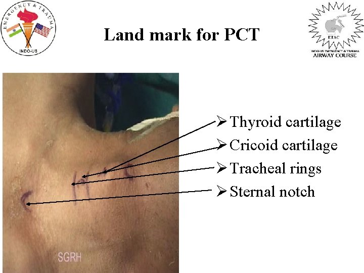 Land mark for PCT Ø Thyroid cartilage Ø Cricoid cartilage Ø Tracheal rings Ø