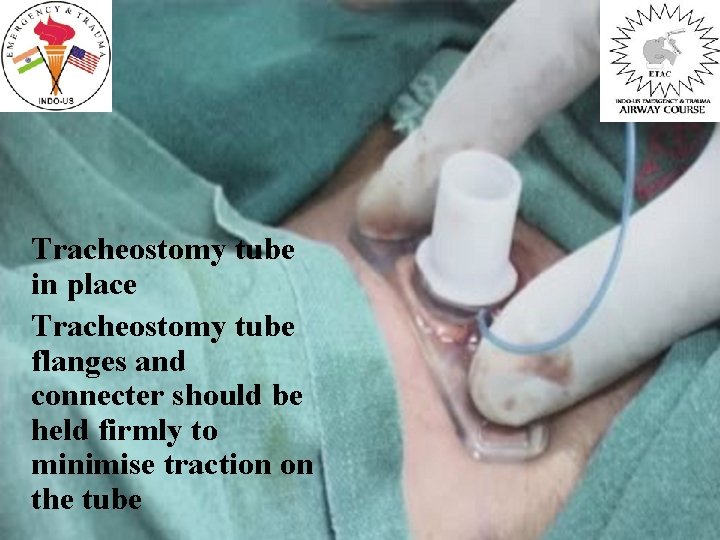 Tracheostomy tube in place Tracheostomy tube flanges and connecter should be held firmly to