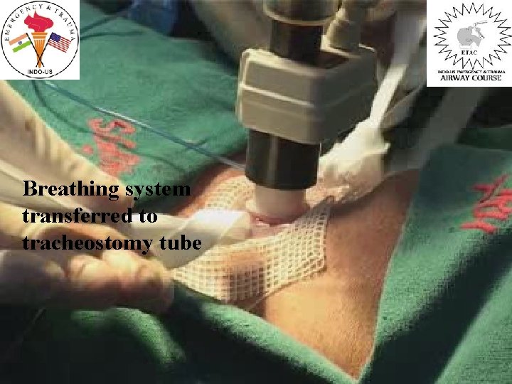 Breathing system transferred to tracheostomy tube 