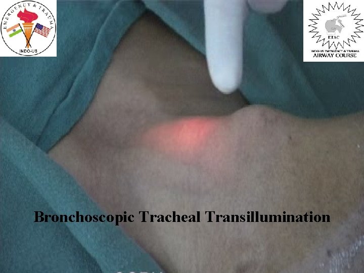 Bronchoscopic Tracheal Transillumination 