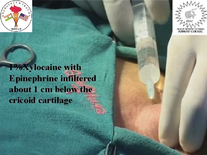 1%Xylocaine with Epinephrine infiltered about 1 cm below the cricoid cartilage 