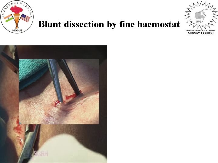 Blunt dissection by fine haemostat 