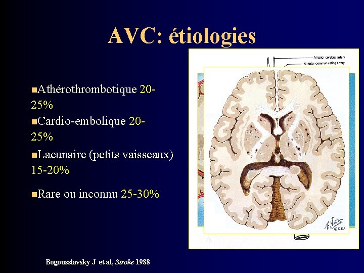 AVC: étiologies n. Athérothrombotique 20 - 25% n. Cardio-embolique 2025% n. Lacunaire (petits vaisseaux)