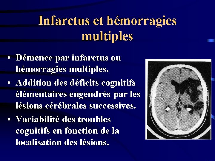 Infarctus et hémorragies multiples • Démence par infarctus ou hémorragies multiples. • Addition des