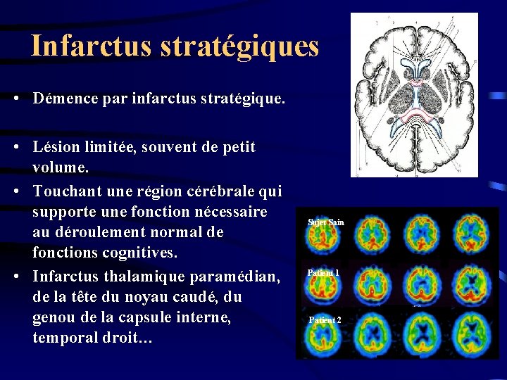 Infarctus stratégiques • Démence par infarctus stratégique. • Lésion limitée, souvent de petit volume.