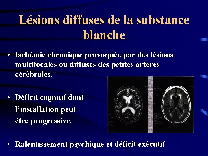 Lésions diffuses de la substance blanche • Ischémie chronique provoquée par des lésions multifocales