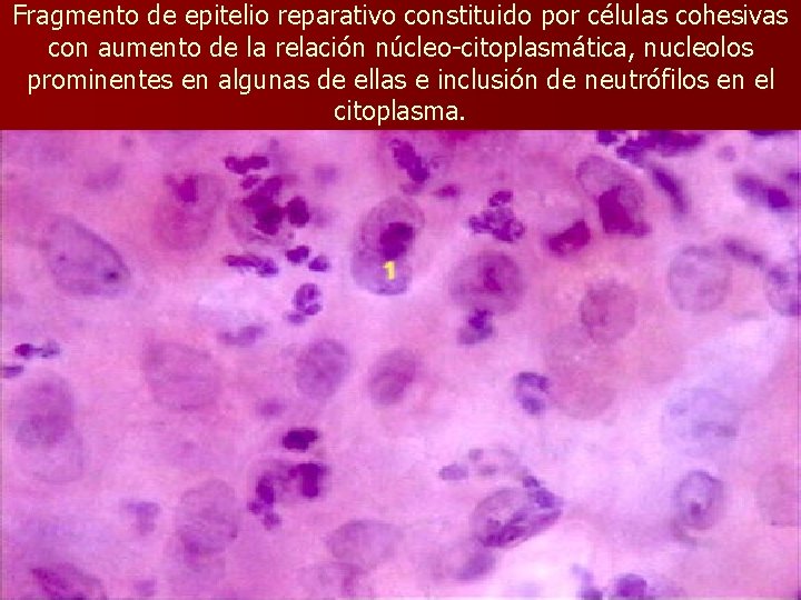 Fragmento de epitelio reparativo constituido por células cohesivas con aumento de la relación núcleo-citoplasmática,