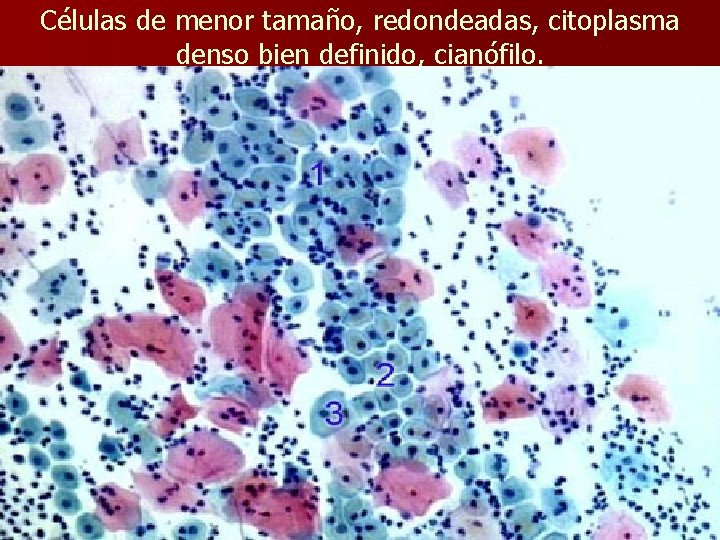 Células de menor tamaño, redondeadas, citoplasma denso bien definido, cianófilo. 