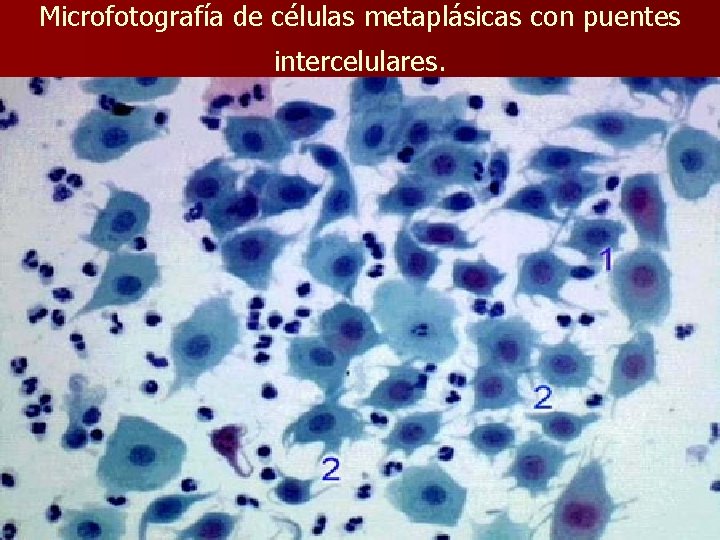 Microfotografía de células metaplásicas con puentes intercelulares. 