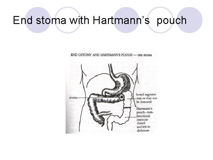 End stoma with Hartmann’s pouch 