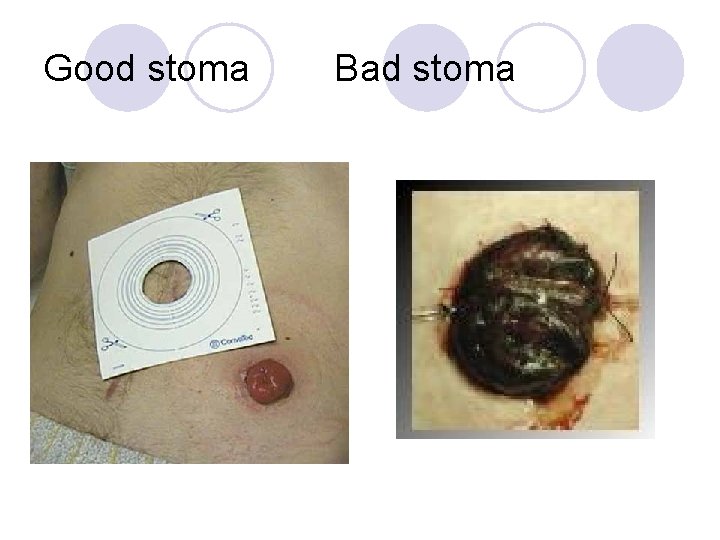 Good stoma Bad stoma 