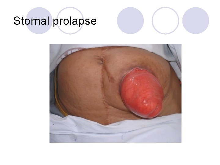 Stomal prolapse 