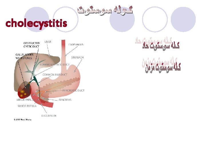 cholecystitis 