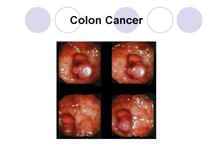 Colon Cancer 