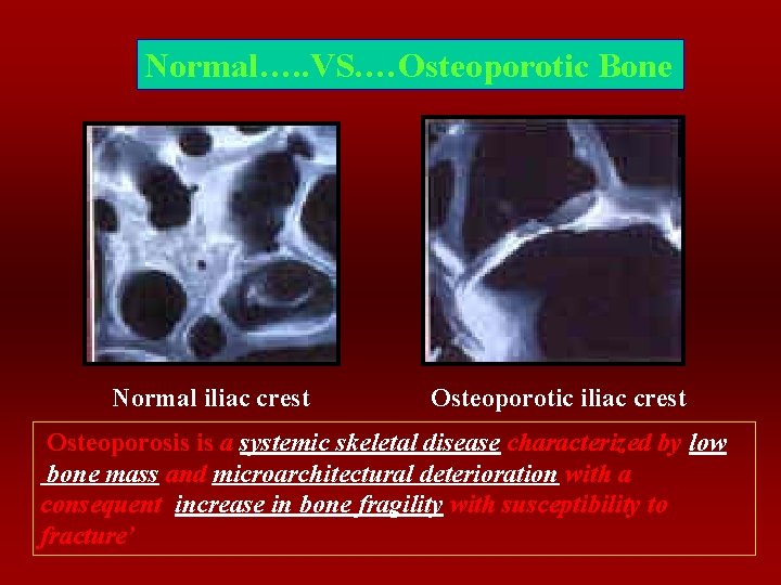 Normal…. . VS. …Osteoporotic Bone Normal iliac crest Osteoporotic iliac crest Osteoporosis is a
