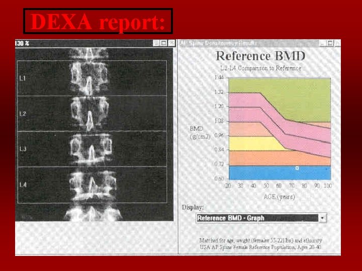 DEXA report: 