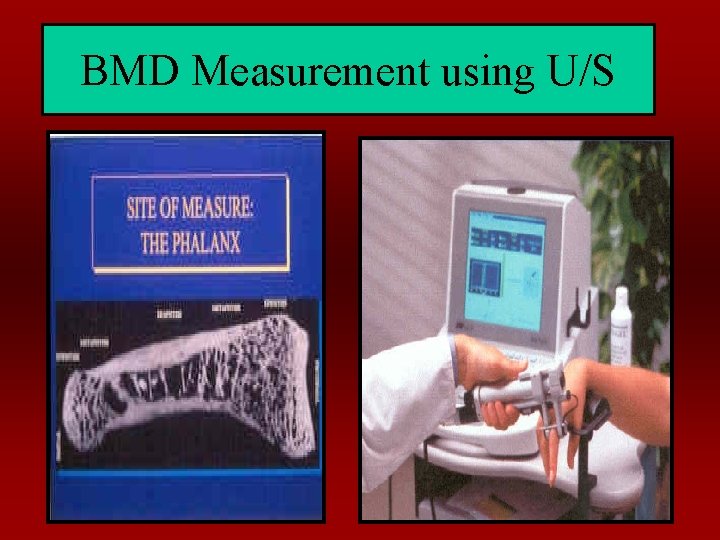 BMD Measurement using U/S 