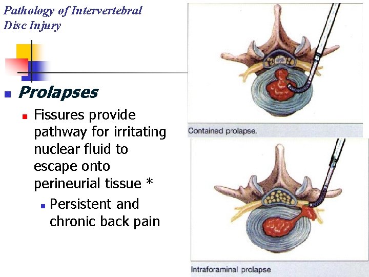 Pathology of Intervertebral Disc Injury n Prolapses n Fissures provide pathway for irritating nuclear