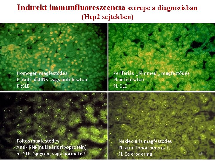 Indirekt immunfluoreszcencia szerepe a diagnózisban (Hep 2 sejtekben) Homogén magfestődés Pl. Anti- ds. DNS