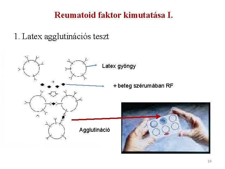 Reumatoid faktor kimutatása I. 1. Latex agglutinációs teszt Latex gyöngy + beteg szérumában RF