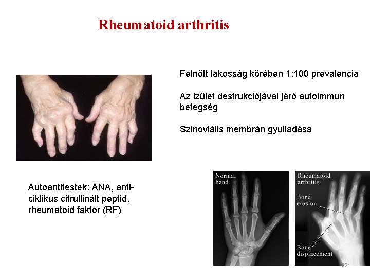 Rheumatoid arthritis Felnőtt lakosság körében 1: 100 prevalencia Az izület destrukciójával járó autoimmun betegség