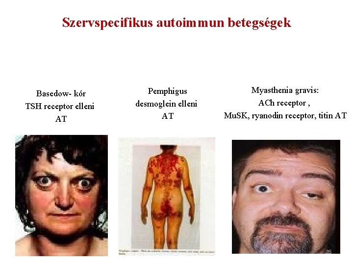 Szervspecifikus autoimmun betegségek Basedow- kór TSH receptor elleni AT Pemphigus desmoglein elleni AT Myasthenia