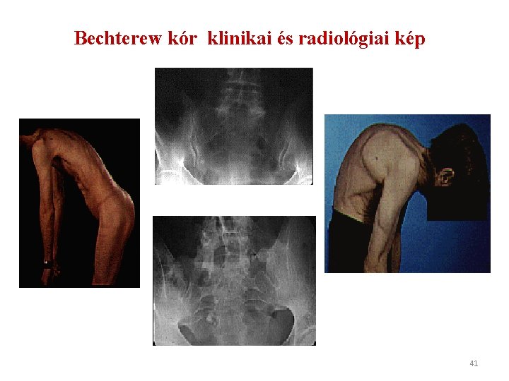 Bechterew kór klinikai és radiológiai kép 41 
