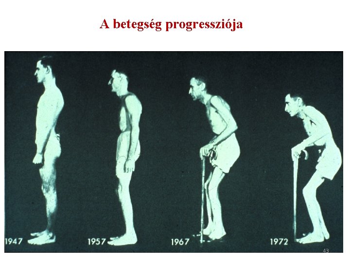 A betegség progressziója 43 