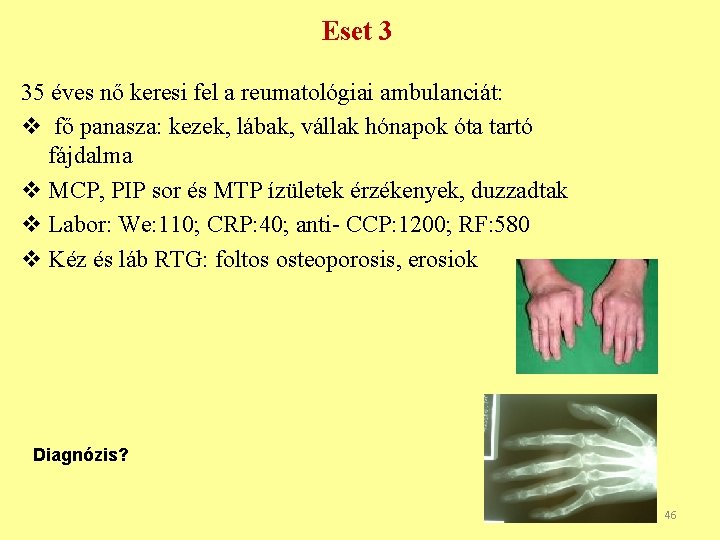 Eset 3 35 éves nő keresi fel a reumatológiai ambulanciát: v fő panasza: kezek,