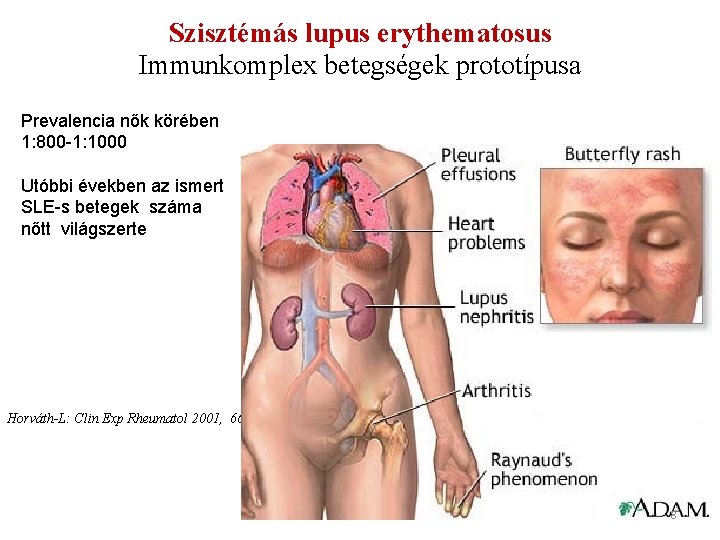 Szisztémás lupus erythematosus Immunkomplex betegségek prototípusa Prevalencia nők körében 1: 800 -1: 1000 Utóbbi