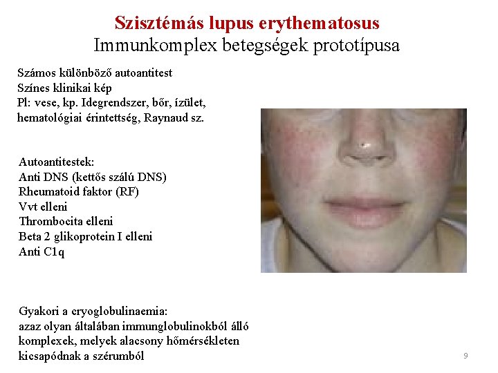 Szisztémás lupus erythematosus Immunkomplex betegségek prototípusa Számos különböző autoantitest Színes klinikai kép Pl: vese,